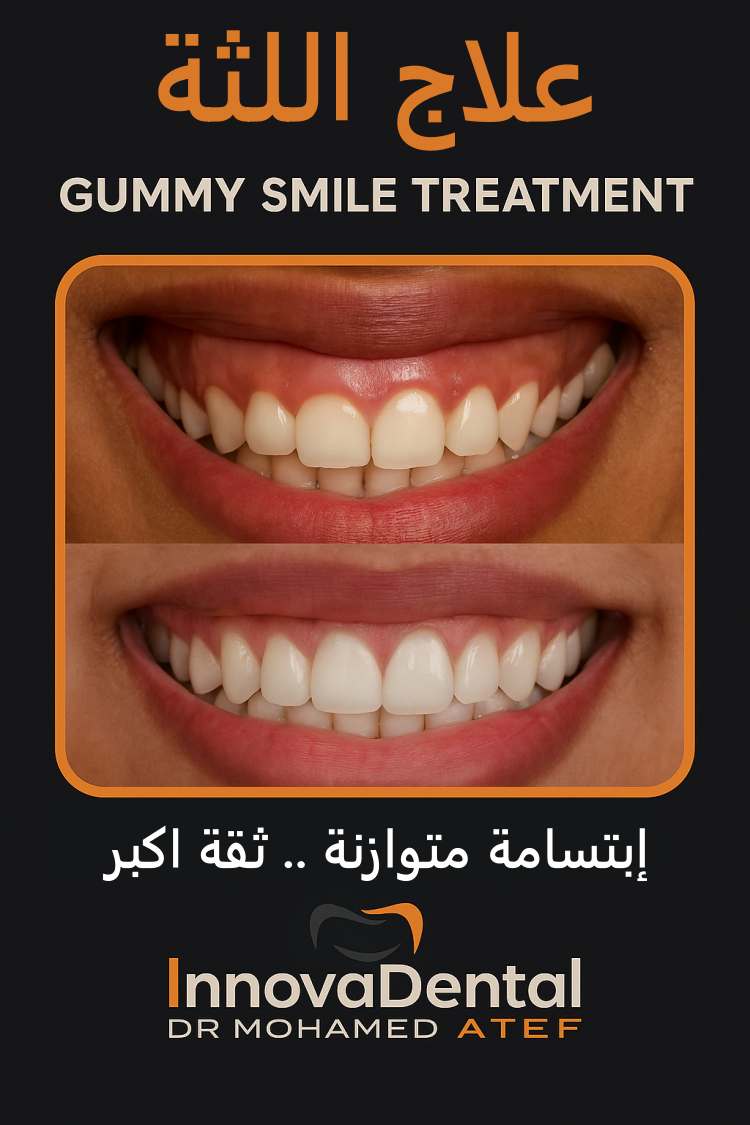 Gum treatment